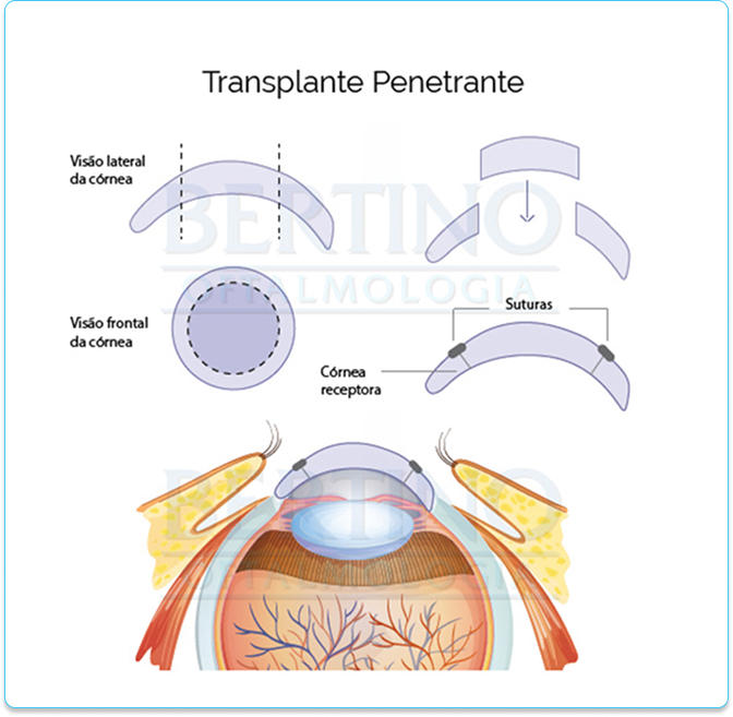 Ilustração: Transplante Penetrante